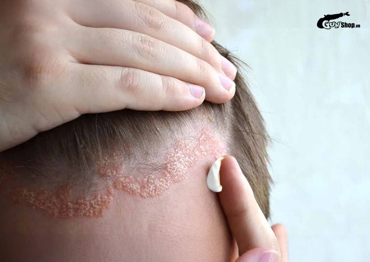 Rụng tóc nhiều là bệnh gì?
