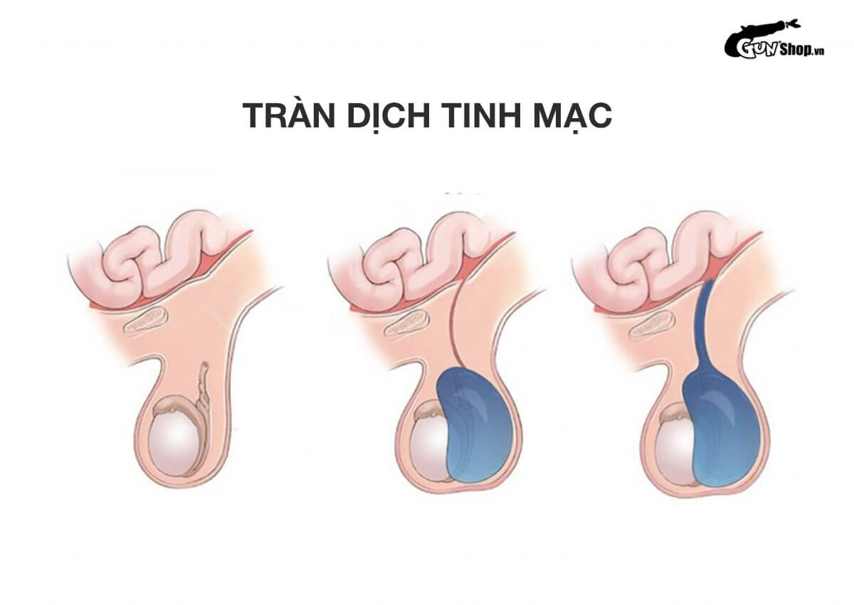 Tràn dịch tinh mạc là gì?