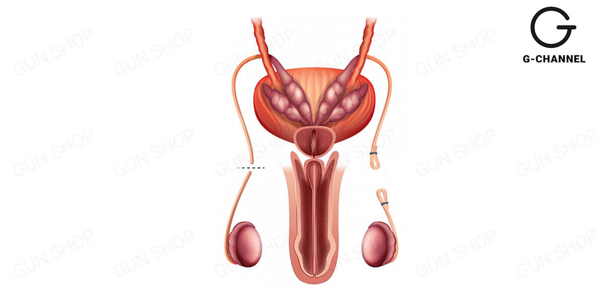 Triệt sản là gì?