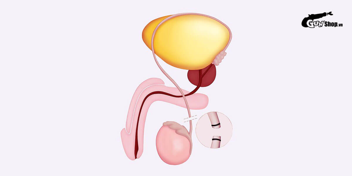 Triệt sản nam có ảnh hưởng gì không?