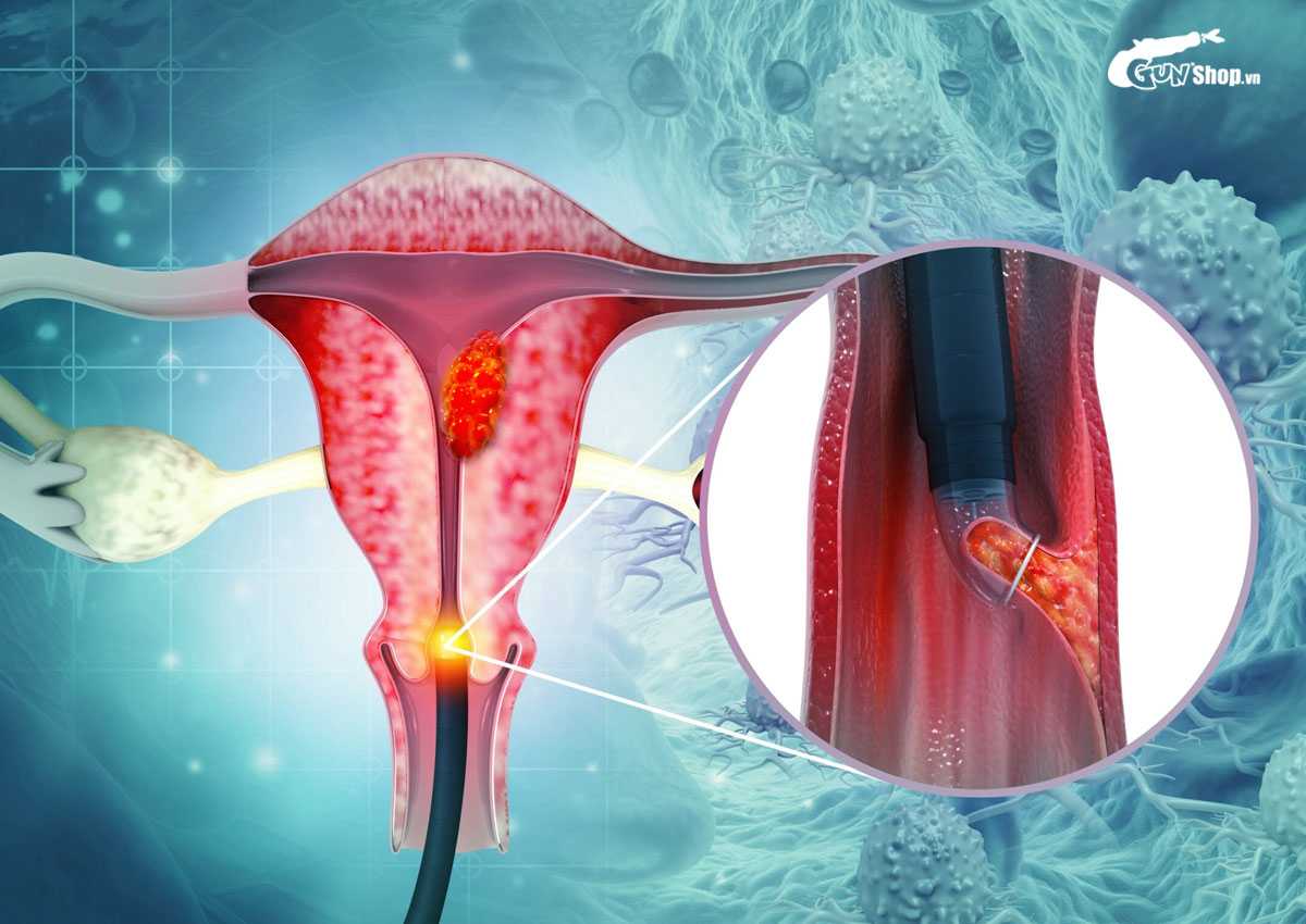 Ung thư cổ tử cung có quan hệ được không?