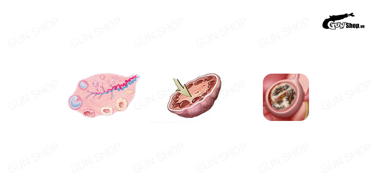 U nang buồng trứng: Nguyên nhân, triệu chứng và hướng điều trị