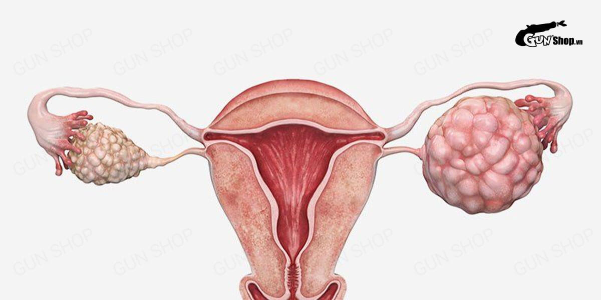 U nang buồng trứng: Nguyên nhân, triệu chứng và hướng điều trị