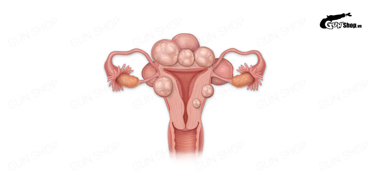 U xơ tử cung: Nguyên nhân, dấu hiệu và cách điều trị hiệu quả