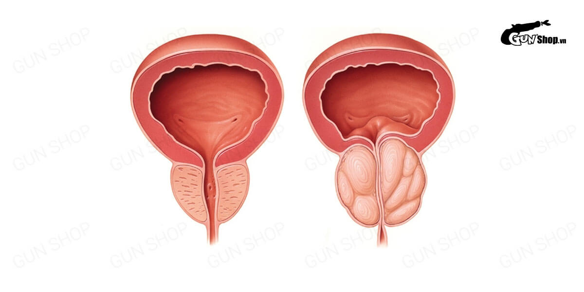 U xơ tuyến tiền liệt thường gặp ở tuổi nào? Điều trị ra sao?