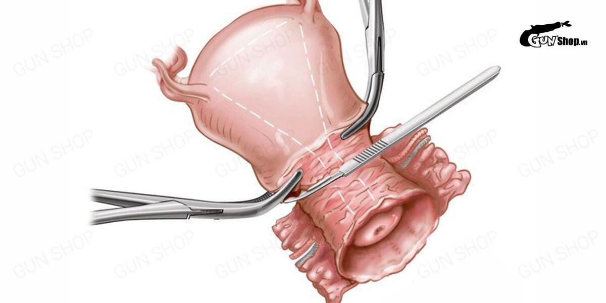 Ung thư cổ tử cung giai đoạn I (giai đoạn đầu): Triệu chứng và cách chữa