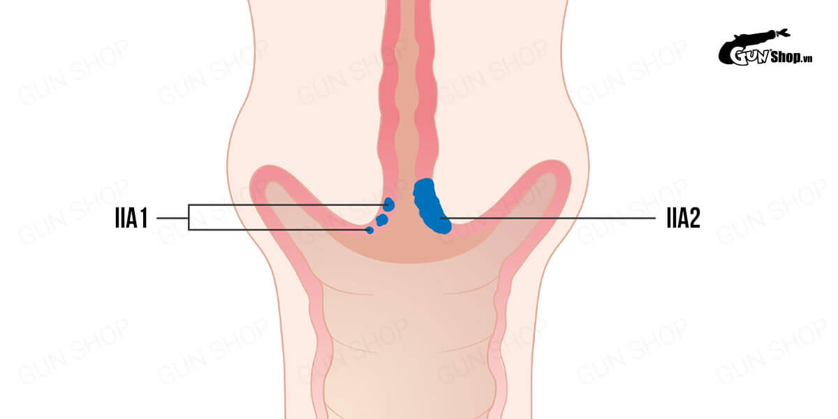 Ung thư cổ tử cung giai đoạn II là gì? Triệu chứng và cách chữa trị?