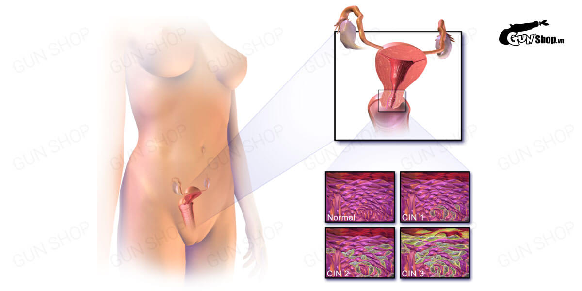 Ung thư cổ tử cung: Dấu hiệu thường gặp và cách phòng ngừa hiệu quả
