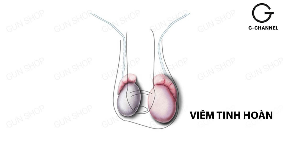 Viêm tinh hoàn do quai bị gây nguy hiểm