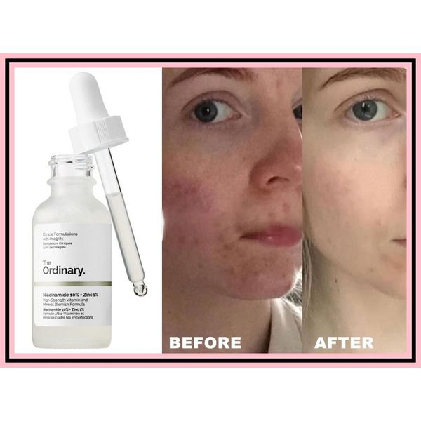 Serum The Ordinary Niacinamide 10% + Zinc 1% 60ml - Tinh ...