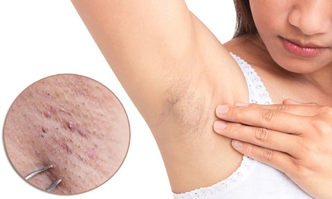Đánh giá mức độ tổn thương da của kem tẩy lông, nhíp và dao cạo
