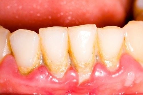 Mảng bám thức ăn là nguy hiểm nhất đối với sự hình thành sâu răng