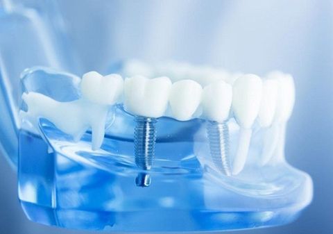 Cấy ghép răng implant - Lấy lại cảm giác cho người mất răng