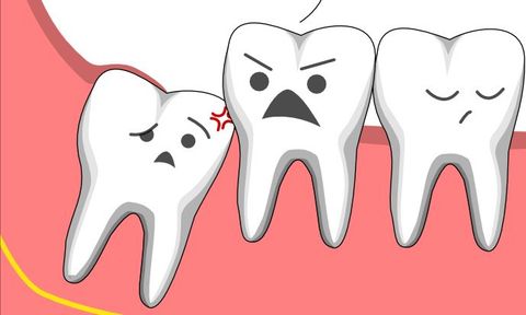 Nhổ răng khôn: An toàn - Không đau - Không biến chứng