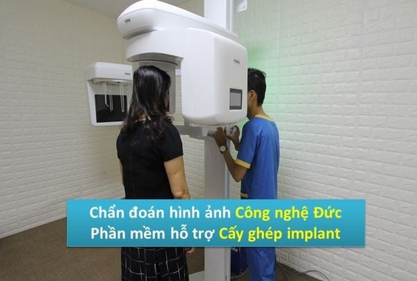 cay-ghep-rang-implant-mat-bao-lau-3