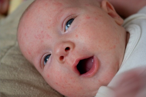 5 dấu hiệu  dễ nhận biết da nhạy cảm cho trẻ sơ sinh