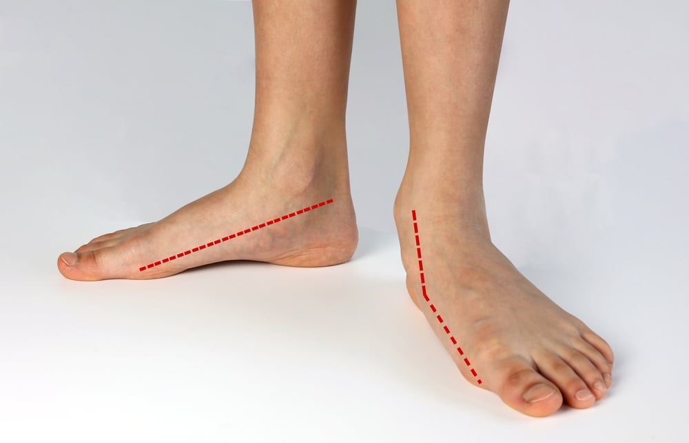Cách buộc dây giày dành cho người có bàn chân phẳng