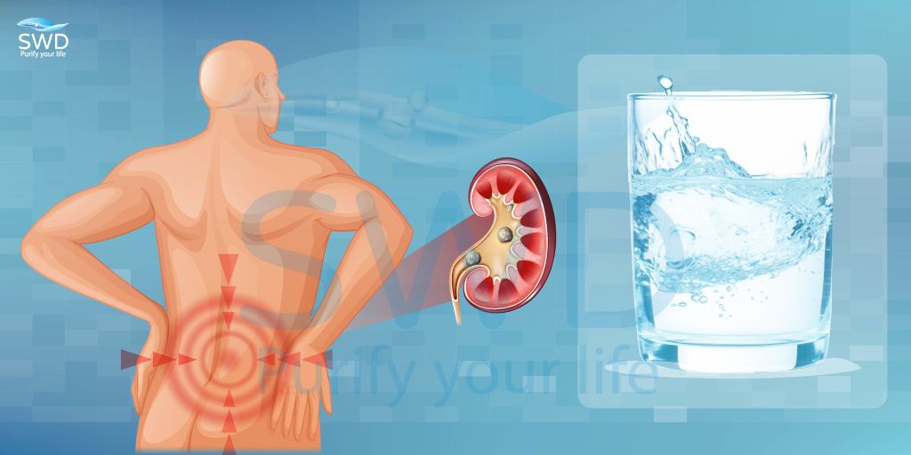 Người Bị Sỏi Thận – Cách Uống Nước Hỗ Trợ Phòng Tái Phát