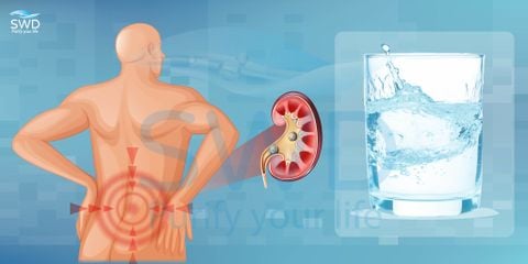 Người Bị Sỏi Thận – Cách Uống Nước Hỗ Trợ Phòng Tái Phát