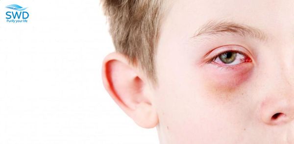 trẻ em bị đau mắt đỏ