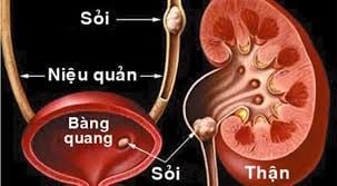 Mổ mở lấy sỏi thận