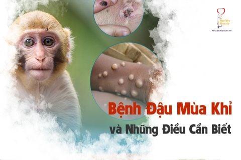 Những Điều Cần Biết Về Bệnh Đậu Mùa Khỉ