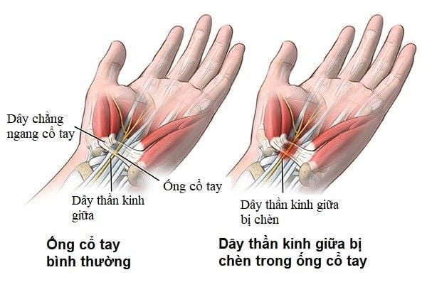 4. Chẩn đoán và xét nghiệm hội chứng ống cổ tay