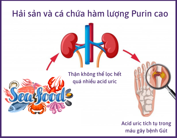 Bệnh Gút nên kiêng ăn gì