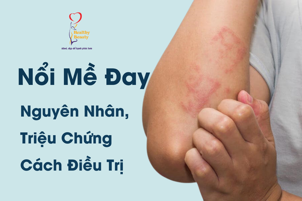 Tìm hiểu về bệnh bạch tạng ở người và cách phòng ngừa hiệu quả