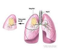 Nguy cơ viêm phế quản phổi ở trẻ nhỏ