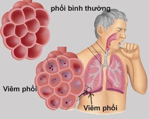 Nguyên tắc trong điều trị viêm phổi