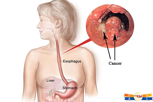 Liệu Pháp Mới Giúp Bệnh Nhân Ung Thư Thận Giai Đoạn Cuối Tại TP HCM Hồi Phục Kỳ Diệu