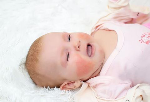 Cách xóa vết bớt trên mặt trẻ sơ sinh? Trị bớt nâu ở trẻ