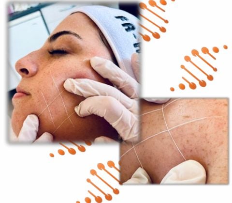 Căng chỉ collagen là gì? Căng da chỉ collagen không kim