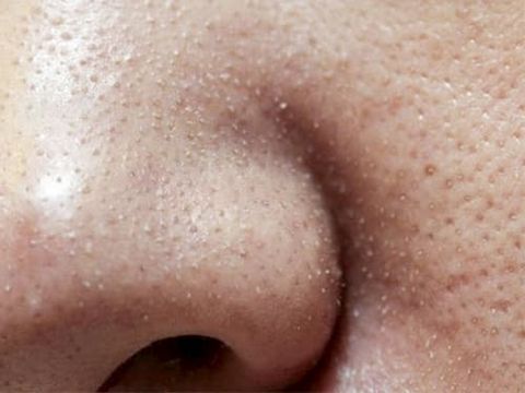 Những cách trị mụn cám ở mũi, cằm nhanh và cực kì hiệu quả