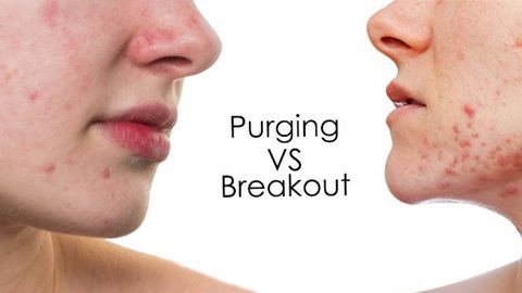 Purging là gì? Break out là gì? Cần làm gì khi da bị “Purging” và “Break out”?