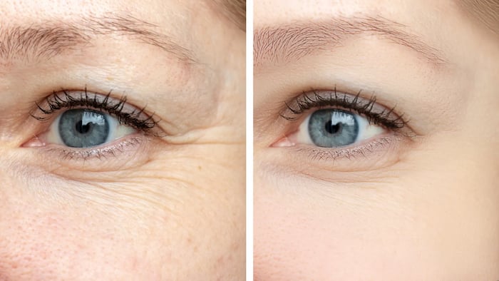 Xóa nhăn vùng mắt giá bao nhiêu? Công nghệ xoá nhăn mắt – Lien Anh Clinic and Beauty