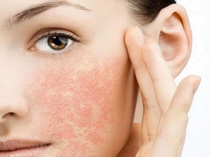 Corticoid là gì? Phục hồi và chăm sóc da mặt bị nhiễm độc Corticoid tại Đà Nẵng