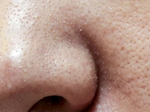 Những cách trị mụn cám ở mũi, cằm tại nhà nhanh và hiệu quả – Lien Anh Clinic and Beauty - Thẩm mỹ viện Đà Nẵng