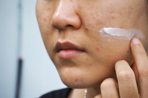 Sử dụng retinoic làm mờ đốm đồi mồi