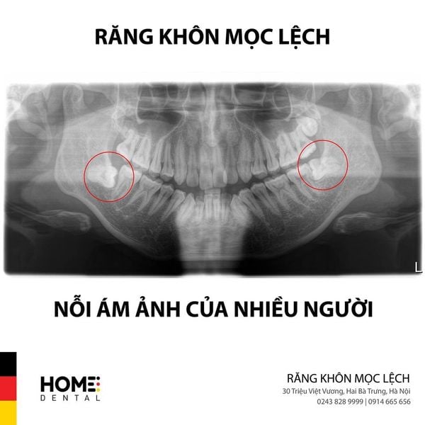 NHỔ RĂNG KHÔN - Nha Khoa Home