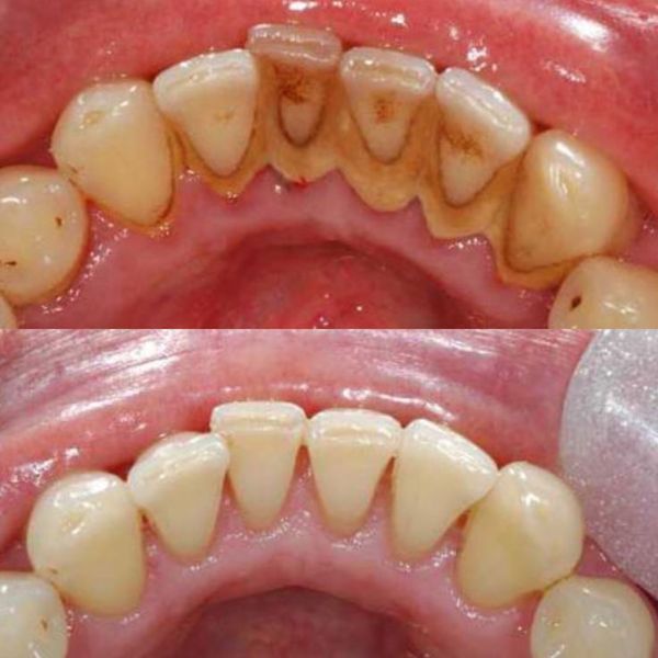 Hình ảnh trước và sau khi lấy cao răng.