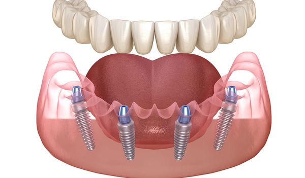 TÌM HIỂU VỀ PHƯƠNG PHÁP CẤY GHÉP IMPLANT ALL ON 4 – Nha khoa Home