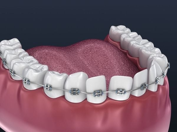 orthodontic-dental-braces-3d
