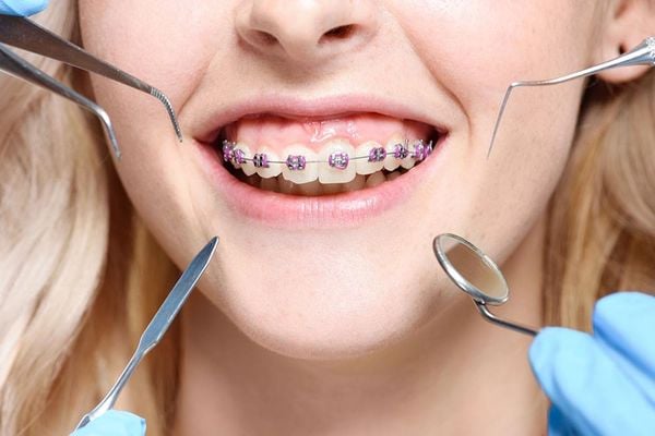 Áp dụng chỉnh nha hợp lý đem lại rất nhiều lợi ích cho hàm răng của bạn.