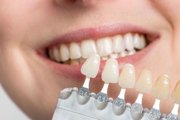 Sự khác biệt giữa veneers, mão răng và implant là gì? Embrace-dental-ortho_veneer-image_1f4d327f8d6749bcb9a49ee18db8b927_grande