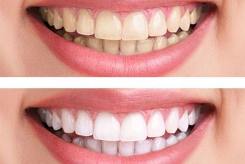 Trước và sau khi tẩy trắng răng thẩm mỹ