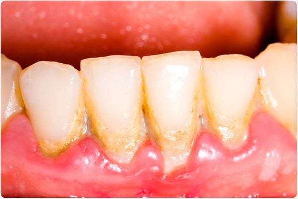Nếu cao răng tích tụ quá nhiều sẽ gây ra các vấn đề răng miệng dai dẳng, khó chịu.