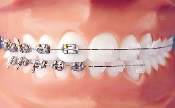 titanium-braces