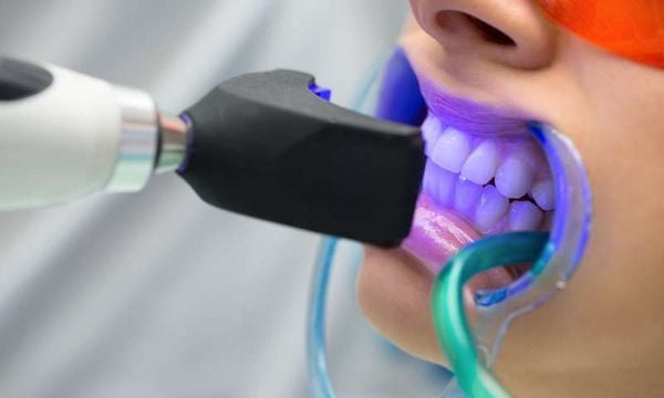 Tẩy răng nha khoa có nhiều công nghệ tiên tiến và an toàn là sự lựa chọn của nhiều người.